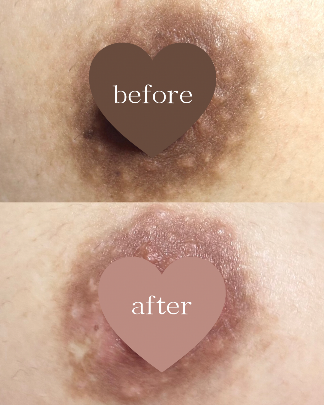 ローマピンク施術による乳輪・乳頭の黒ずみ改善症例（施術前と2ヶ月後の経過）