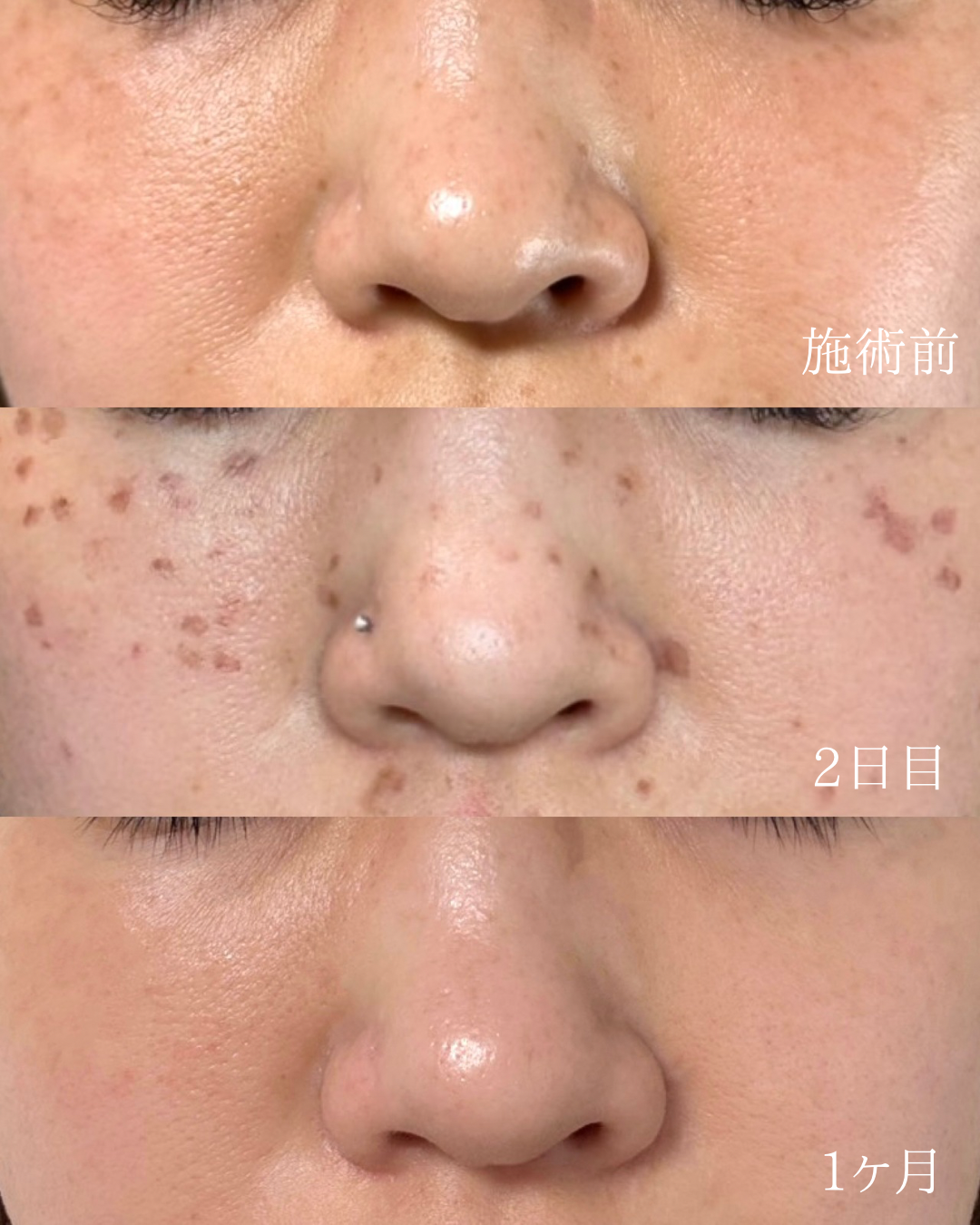 顔全体のシミ取り症例（施術前 / 2日後 / 1ヶ月後）