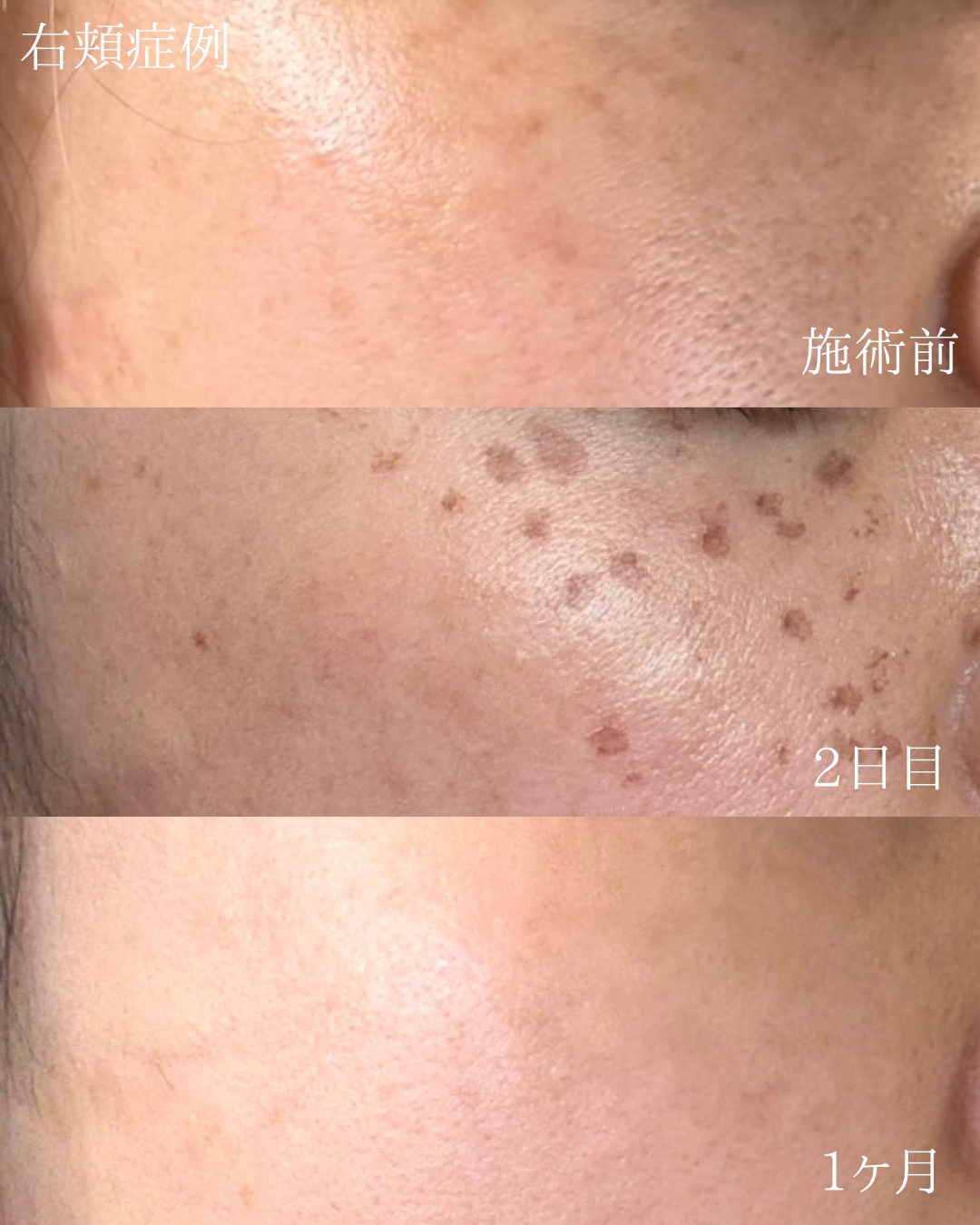 シミ取り施術の右頬症例（施術前・2日後・1ヶ月後）