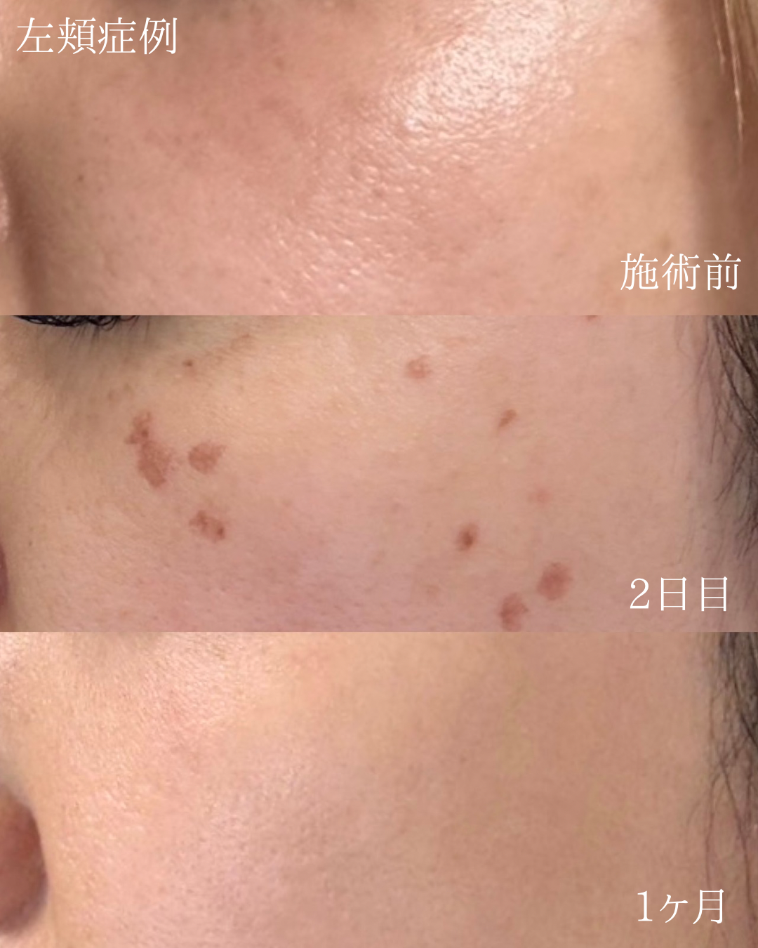 シミ取り施術の左頬症例（施術前・2日後・1ヶ月後）