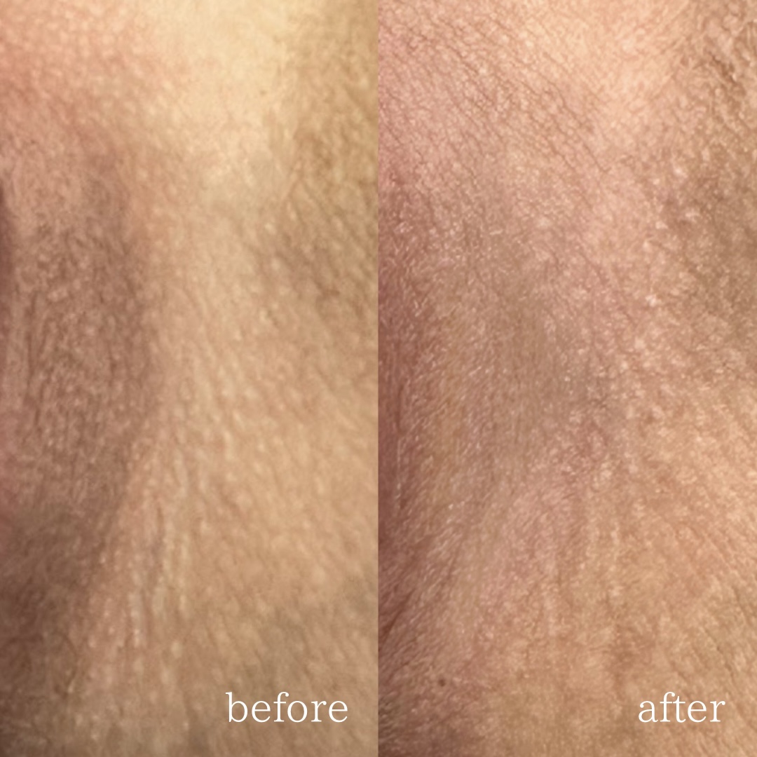 ローマピンク施術によるデリケートゾーンの黒ずみ改善症例（施術前と3ヶ月後の比較）