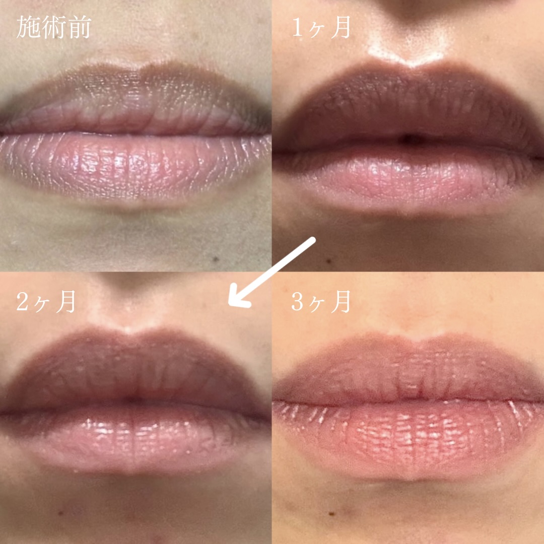 ローマピンク施術による唇のくすみ改善症例（施術前・1ヶ月・2ヶ月・3ヶ月の経過）