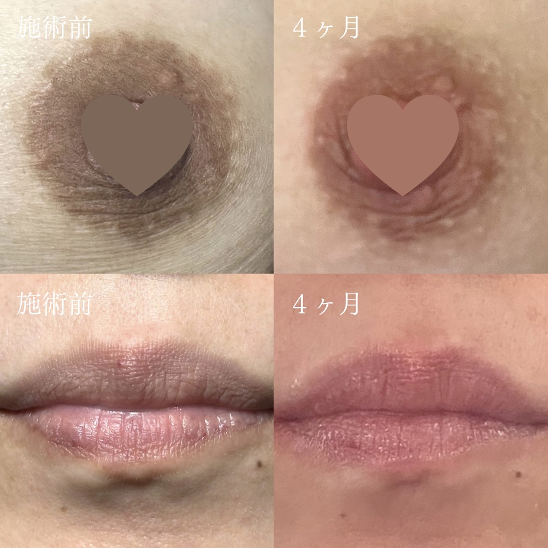 ローマピンク リップ 乳輪 1回施術 3ヶ月 4ヶ月後 ビフォーアフター 黒ずみ改善