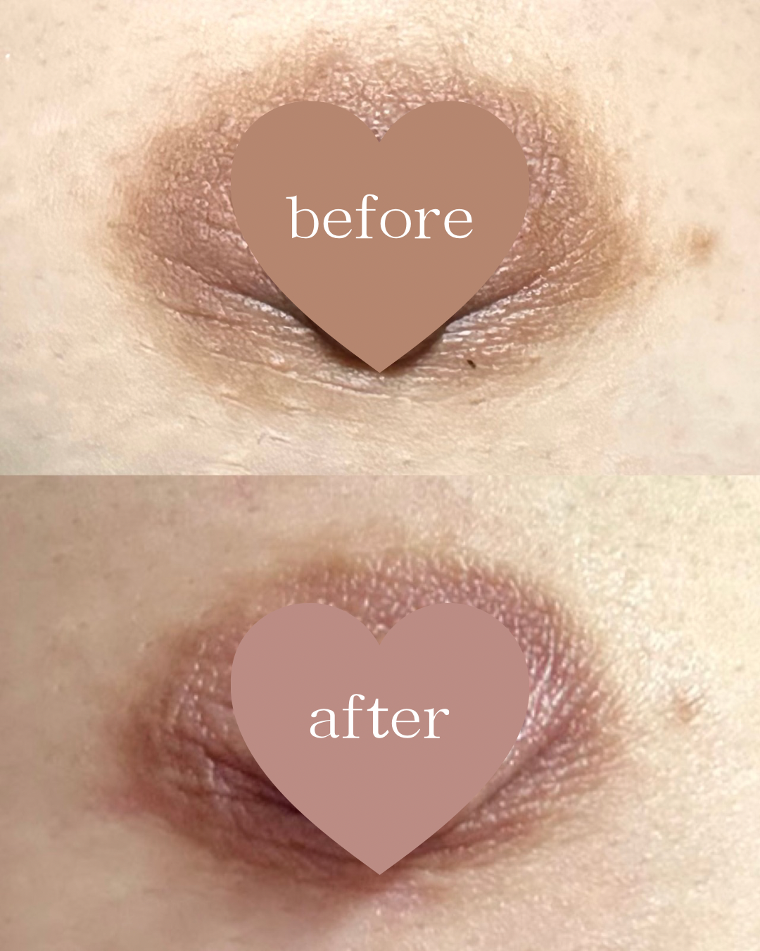 ローマピンク施術による乳輪・乳頭の黒ずみ改善症例（施術前と2ヶ月後の経過）