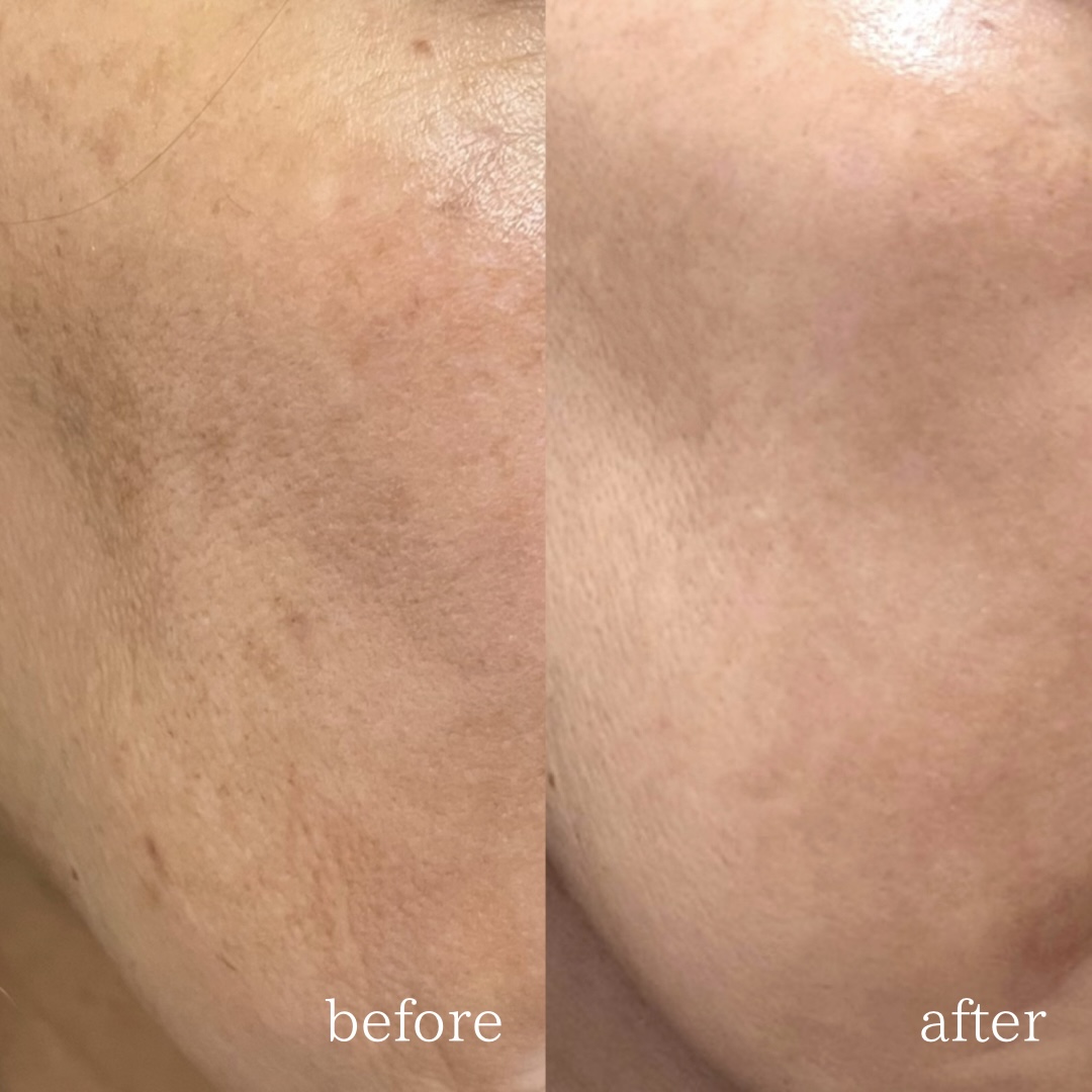 シミ取り施術による全顔のシミ改善症例（施術前と1ヶ月後の比較）