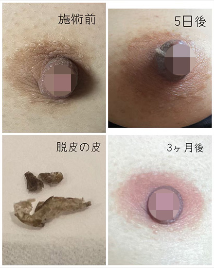 ニップル
