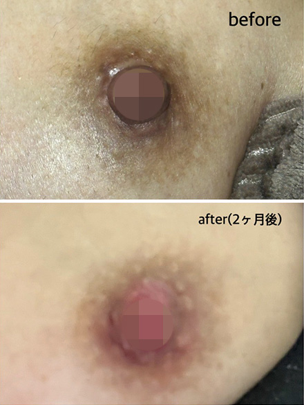 ニップル