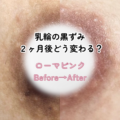 乳輪の黒ずみ、2ヶ月後どう変わる？ローマピンク施術2ヶ月後の経過