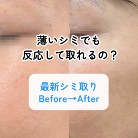 シミ取り 薄いシミ 1回施術 3ヶ月後 ビフォーアフター 全顔