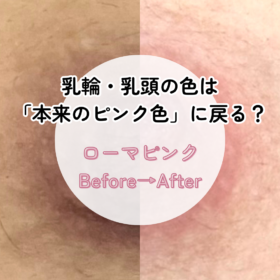 ローマピンク 乳輪 乳頭 黒ずみ改善 1回施術 3ヶ月後 ビフォーアフター