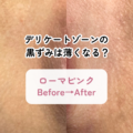 デリケートゾーンの黒ずみは薄くなる？3ヶ月後のリアルな変化