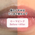 唇のくすみはどこまで変わる？ローマピンク施術前から3ヶ月までの経過を公開