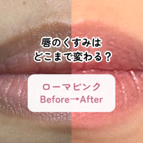 ローマピンク施術による唇のくすみ・色ムラ改善症例（施術前・1ヶ月・2ヶ月・3ヶ月の経過）