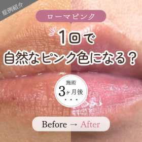 ローマピンク リップ 1回施術 3ヶ月後 ビフォーアフター 唇のくすみ改善