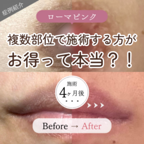 ローマピンク リップ 乳輪 1回施術 3ヶ月 4ヶ月後 ビフォーアフター 黒ずみ改善