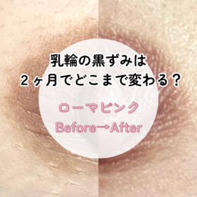 ローマピンク施術による乳輪・乳頭の黒ずみ改善症例（施術前と2ヶ月後の経過）