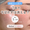 最新のシミ取りでそばかすは消える?全顔1回施術・1ヶ月後の変化