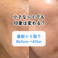 小さなシミでも印象は変わる｜シミ取り1回・1ヶ月後の変化