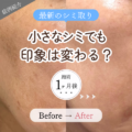 小さなシミでも印象は変わる｜シミ取り1回・1ヶ月後の変化