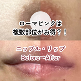 ローマピンク リップ 乳輪 1回施術 3ヶ月 4ヶ月後 ビフォーアフター 黒ずみ改善