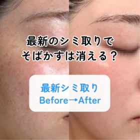 シミ取り 全顔 そばかす 1回施術 3ヶ月後 ビフォーアフター 肌トーン改善