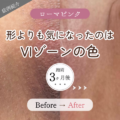 「形よりも色が気になった」VIゾーンの黒ずみが3ヶ月でここまで変化