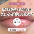 学生時代の頃からの悩みをどこまで変化させれる？唇のくすみ3ヶ月後の症例