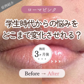 ローマピンク 唇 くすみ改善 1回施術 3ヶ月後 ビフォーアフター 血色アップ