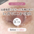 「出産してから色が戻らない…」乳輪の黒ずみが3ヶ月でここまで変化