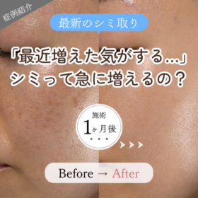 シミ取り 全顔 肝斑 そばかす 1回施術 1ヶ月後 ビフォーアフター
