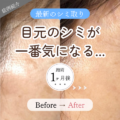 目元のシミが気になる方へ｜シミ取り1回・2.5ヶ月後のビフォーアフター