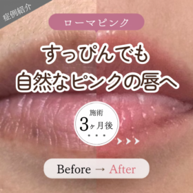 ローマピンク リップ 1回施術 3ヶ月後 唇のくすみ ビフォーアフター
