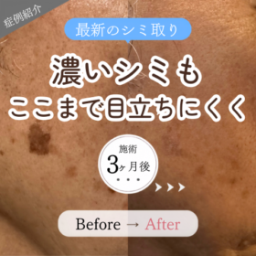 シミ取り 老人性色素斑 1ヶ所 1回施術 3ヶ月後 ビフォーアフター